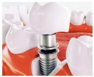 Dental Implant in Perth