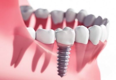 Perth Dental Implants